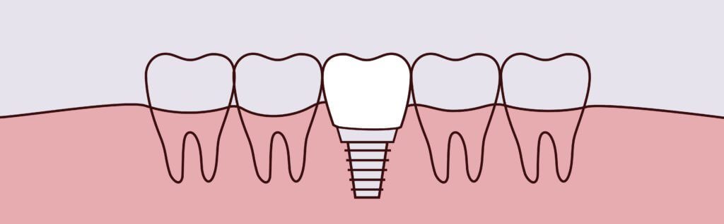 Yerra Family Dentistry - Woodinville Dentist Yerra Family Dentistry - Woodinville Dentist